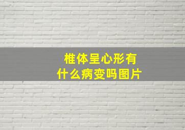 椎体呈心形有什么病变吗图片