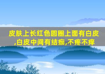 皮肤上长红色圆圈上面有白皮,白皮中间有结痂,不疼不痒